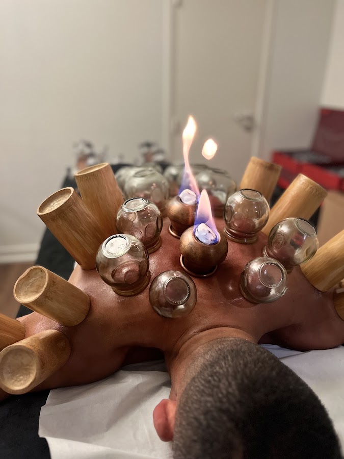 Hijama/Cupping Centre Medical OP Santé
